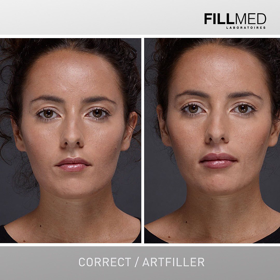 مزو تخصصی فیلمد