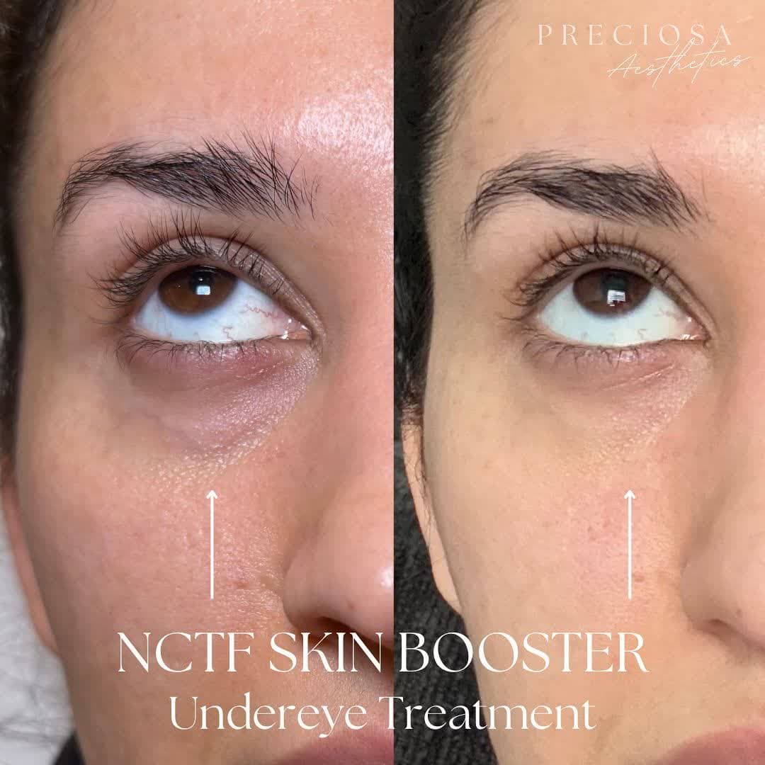 مزو تخصصی زوشن کننده