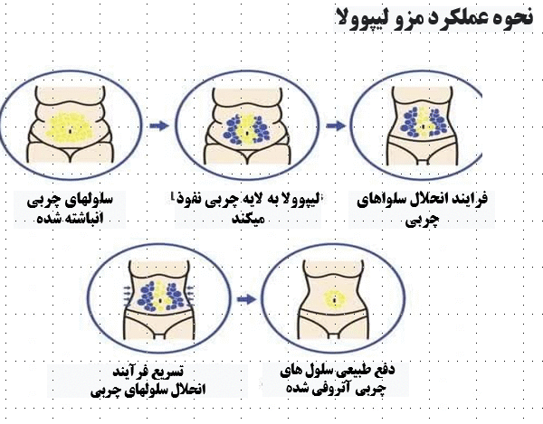 مزو لاغری لیپوولا